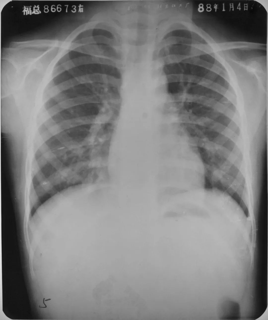 胸部 CT 入门：6 种最常见征象 + 相关疾病介绍 - 呼吸与胸部疾病讨论版 -丁香园论坛