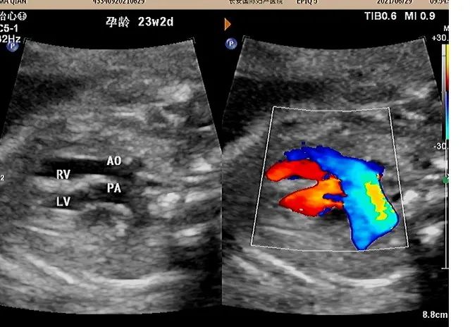 疑难病例 | 产前超声诊断中的异常病例