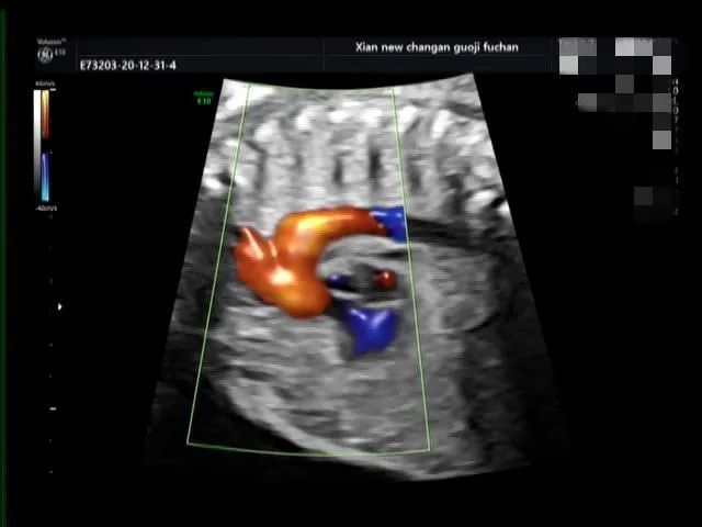 疑难病例 | 产前超声诊断中的异常病例