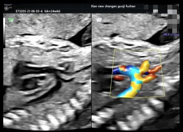 疑难病例 | 产前超声诊断中的异常病例
