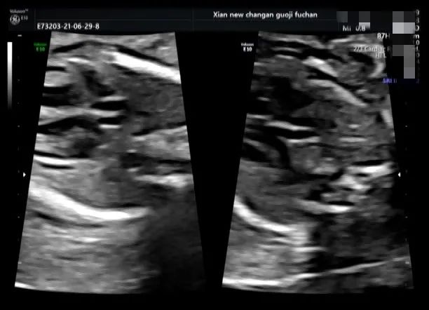 疑难病例 | 产前超声诊断中的异常病例
