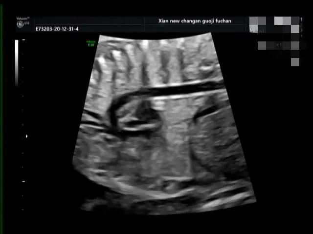 疑难病例 | 产前超声诊断中的异常病例