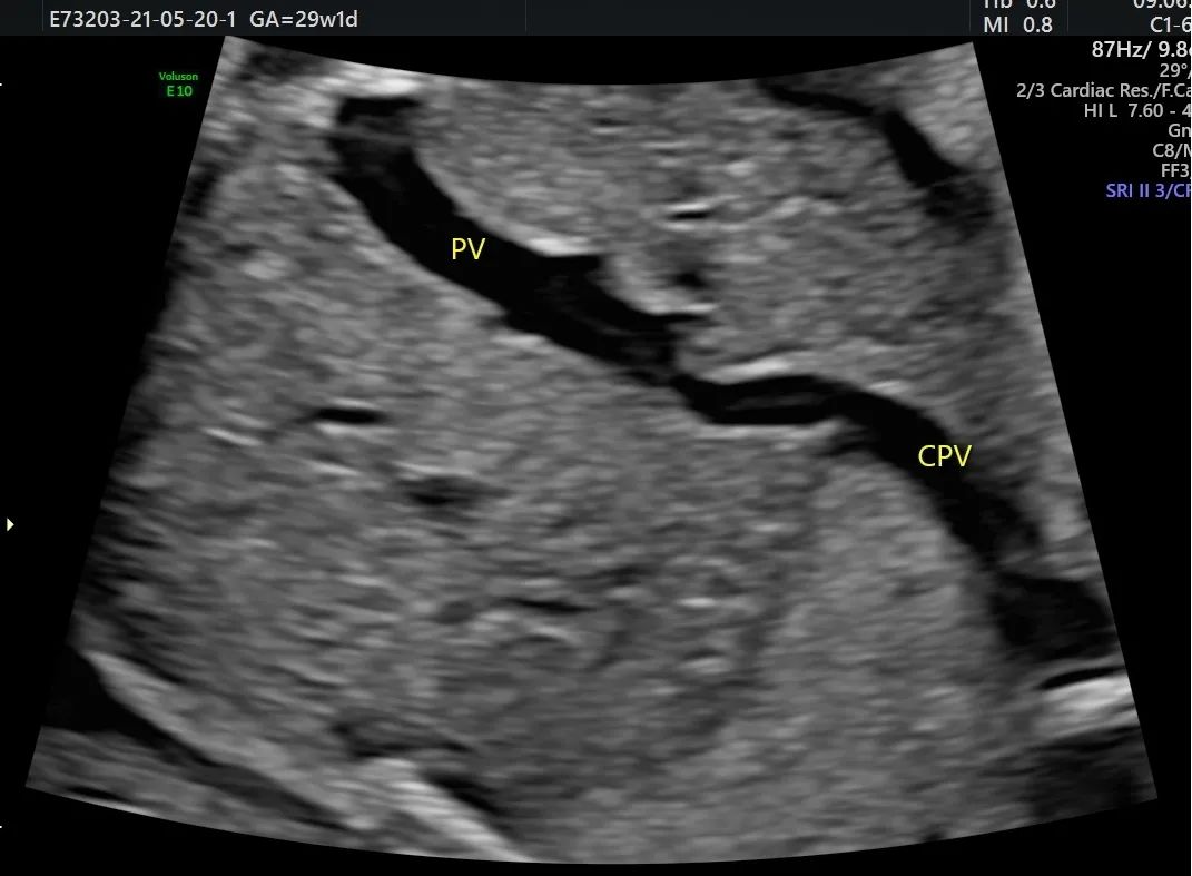 疑难病例 | 产前超声诊断中的异常病例