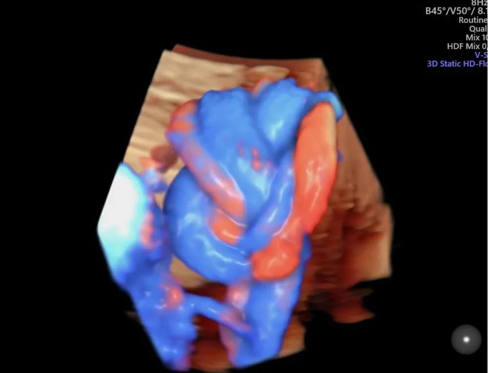 疑难病例 | 产前超声诊断中的异常病例