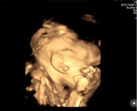 疑难病例 | 产前超声诊断中的异常病例