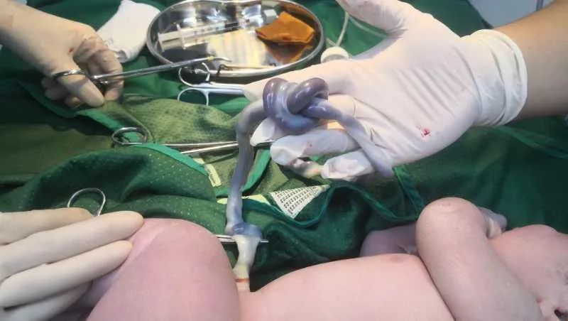 疑难病例 | 产前超声诊断中的异常病例