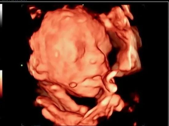 疑难病例 | 产前超声诊断中的异常病例