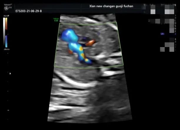 疑难病例 | 产前超声诊断中的异常病例