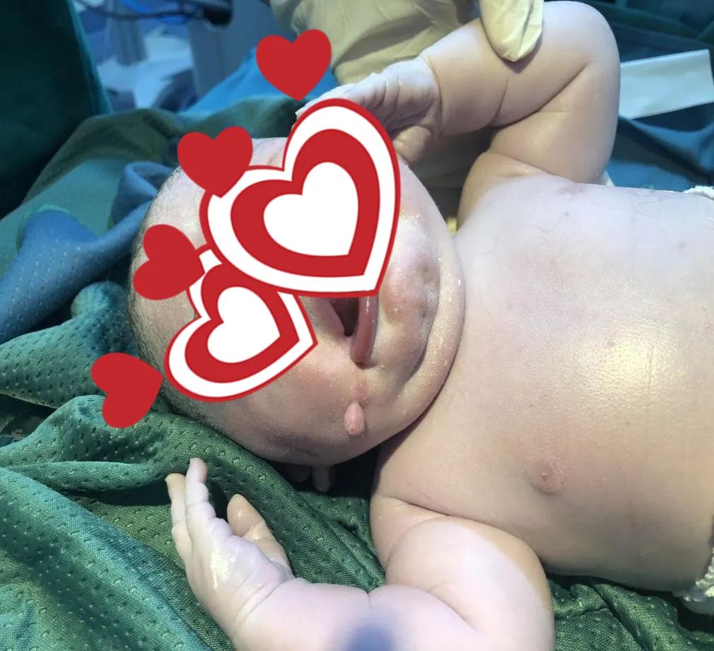 疑难病例 | 产前超声诊断中的异常病例