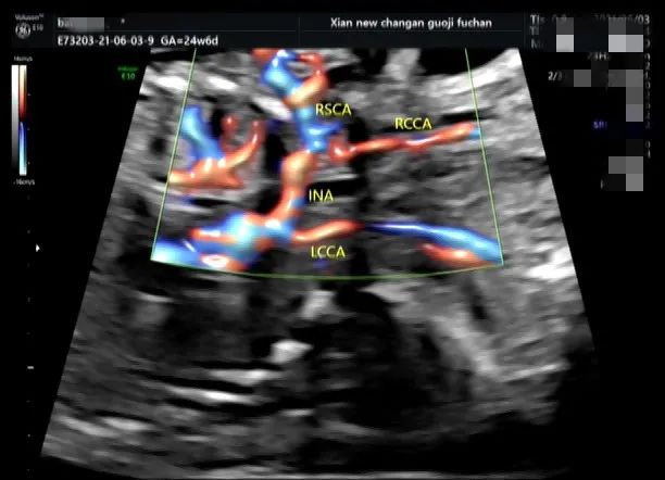 疑难病例 | 产前超声诊断中的异常病例