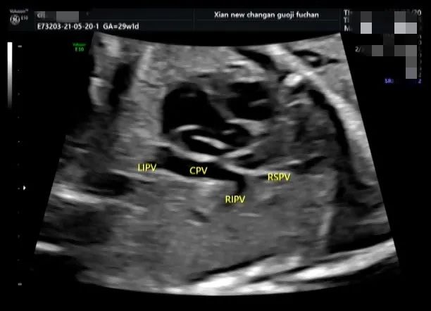 疑难病例 | 产前超声诊断中的异常病例