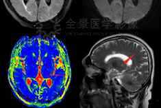 世界卒中日 | 小心，按摩不当会导致中风