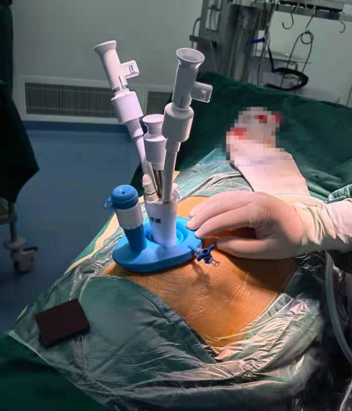 南京医科大学第二附属医院开展国内首例经腰单孔机器人肾上腺肿瘤切除术
