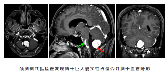 生命禁区在哪里？带你了解高难度脑干肿瘤手术