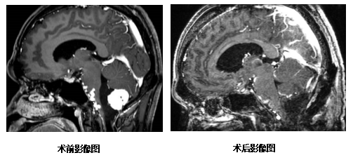 生命禁区在哪里？带你了解高难度脑干肿瘤手术