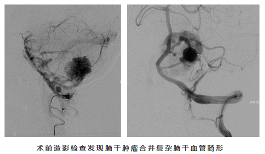 生命禁区在哪里？带你了解高难度脑干肿瘤手术