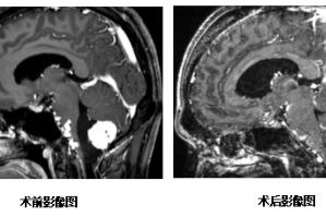 生命禁区在哪里？带你了解高难度脑干肿瘤手术