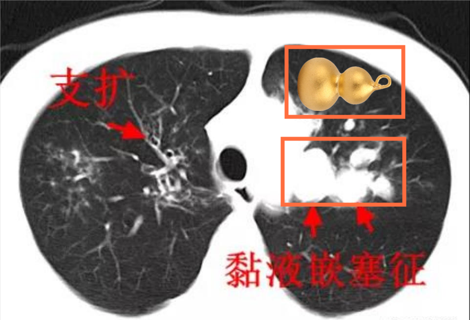 能让支气管「情不自禁」变葫芦  这个病菌折磨小伙 10 多年却让结核病「背锅」  三类人群要小心提防它！