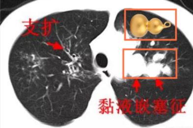 能让支气管「情不自禁」变葫芦  这个病菌折磨小伙 10 多年却让结核病「背锅」  三类人群要小心提防它！