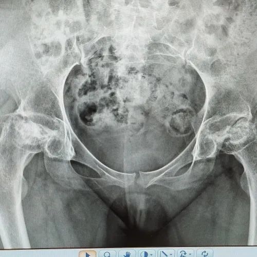 成都京东方医院骨科竭力救治三位豆蔻少年