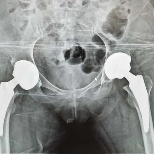 成都京东方医院骨科竭力救治三位豆蔻少年