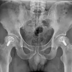 成都京东方医院骨科竭力救治三位豆蔻少年