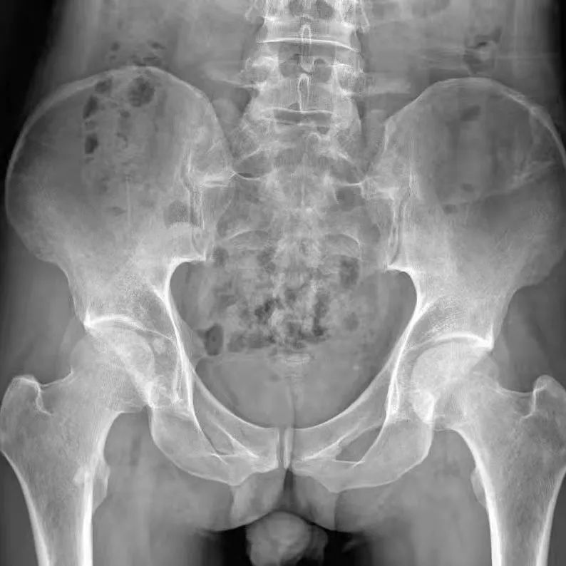 成都京东方医院骨科竭力救治三位豆蔻少年