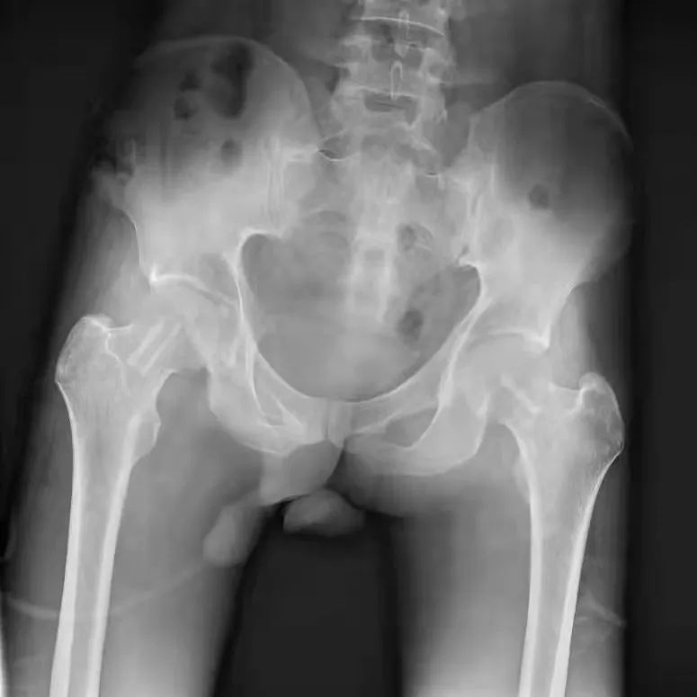 成都京东方医院骨科竭力救治三位豆蔻少年