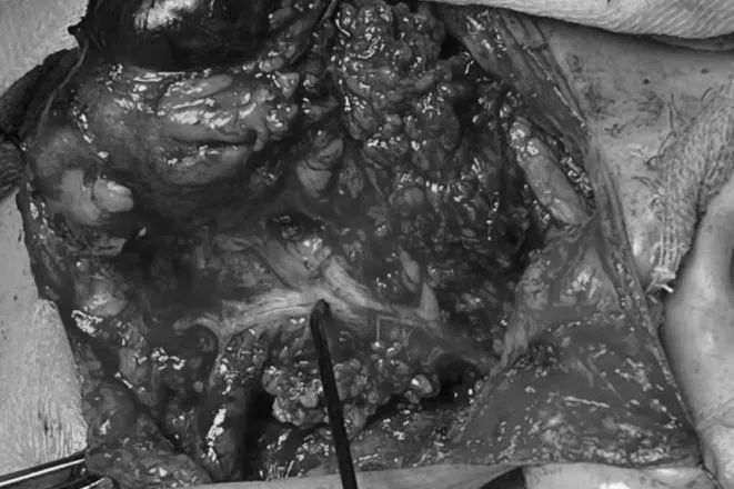 腮腺「鼓包」别害怕 术中「神探」来护驾