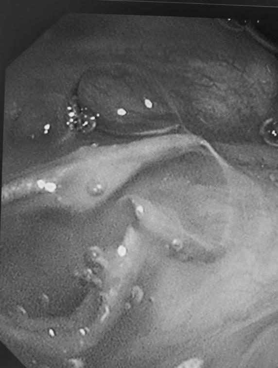肺癌手术 9 年后再胸痛  原来是一颗「脱岗」的钉子在捣乱  避免这样的后患 术后静养少不得        
