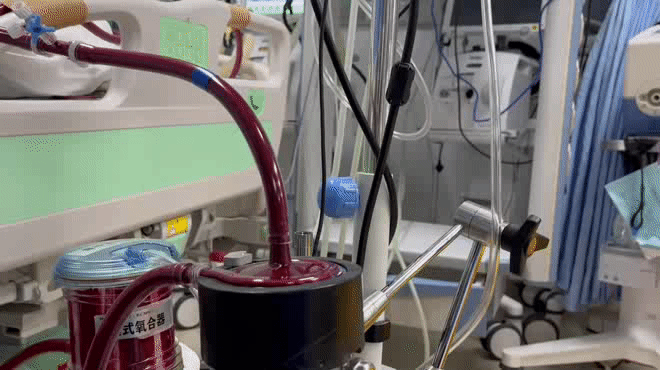 国产 ECMO 研发新突破，在西安交大一附院率先临床应用