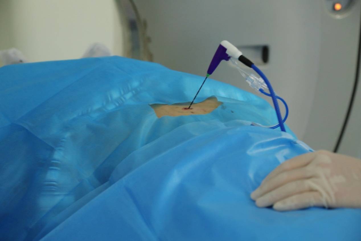 泸州市中医医院首例三维标测下房颤心脏射频消融术