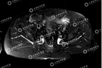 日常无症状，全身 mMR 意外发现了恶性肿瘤