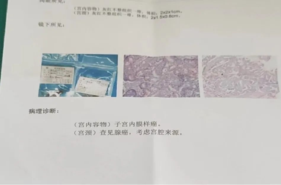 高尚病例：如何认知、早发现子宫内膜癌