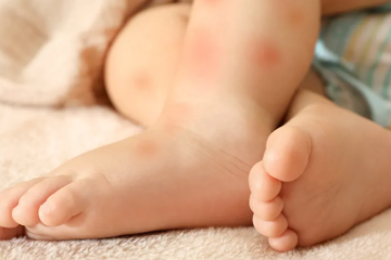 宝宝过敏怎样快速消除, 经常反复过敏怎么治？