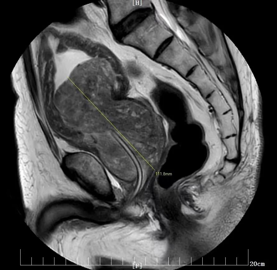 西安高新医院泌尿外科使用钬激光完成巨大前列腺剜除