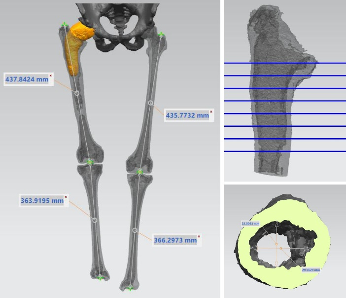 关节外科运用人工智能及 3D 打印辅助实施全球最大髋翻修巨型假体植入手术