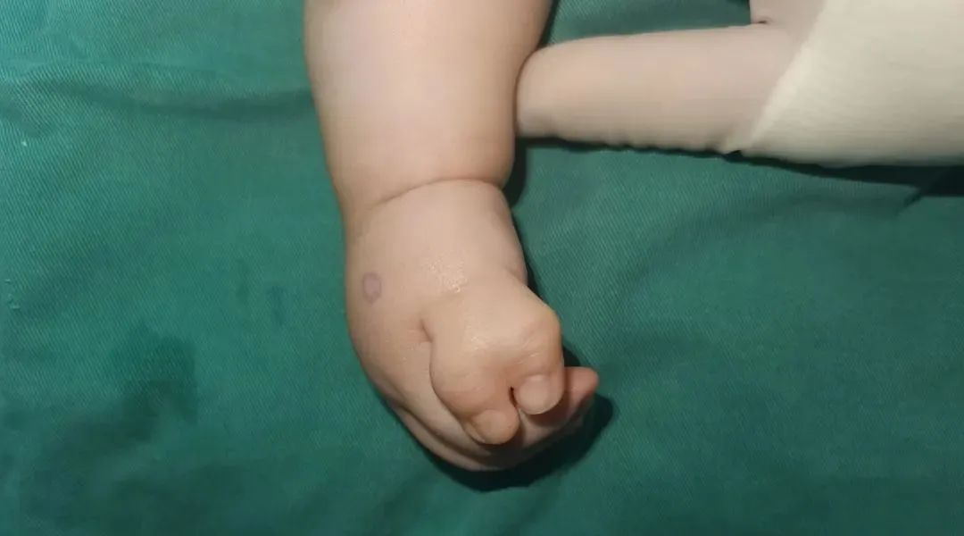 罕见！6 个月男宝宝手指形似「蟹钳」……