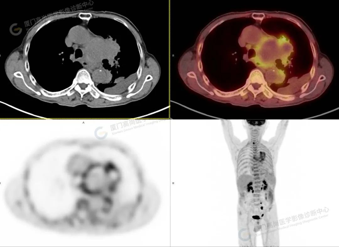 高尚病例:18F-PET/CT 意外发现「主动脉瘤破裂」挽回患者生命