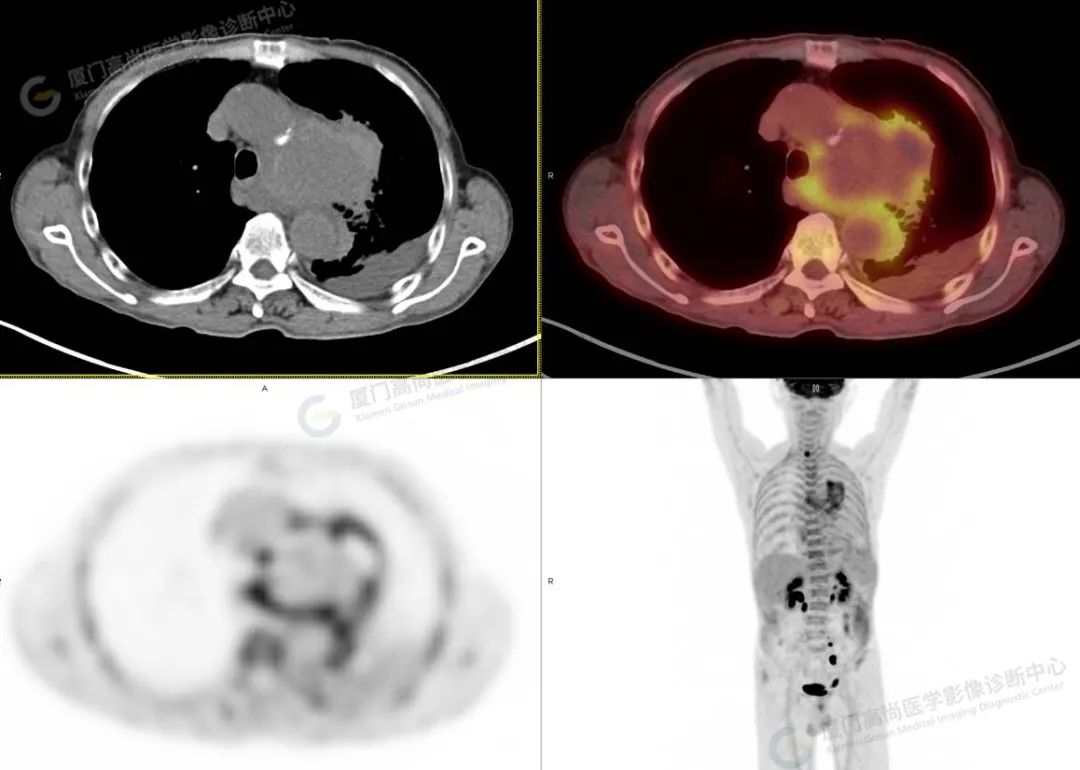 高尚病例:18F-PET/CT 意外发现「主动脉瘤破裂」挽回患者生命