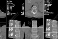 QCT 对中青年骨质疏松的评估诊断实例