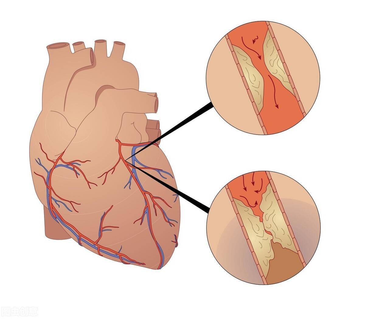 N-末端脑钠肽前体检测试剂盒（荧光免疫层析法）
