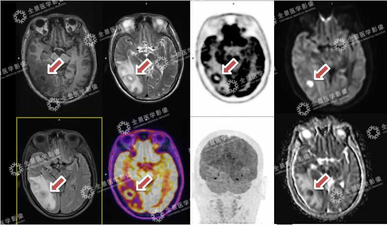 开颅手术还是继续观察？PET/MR 给出答案