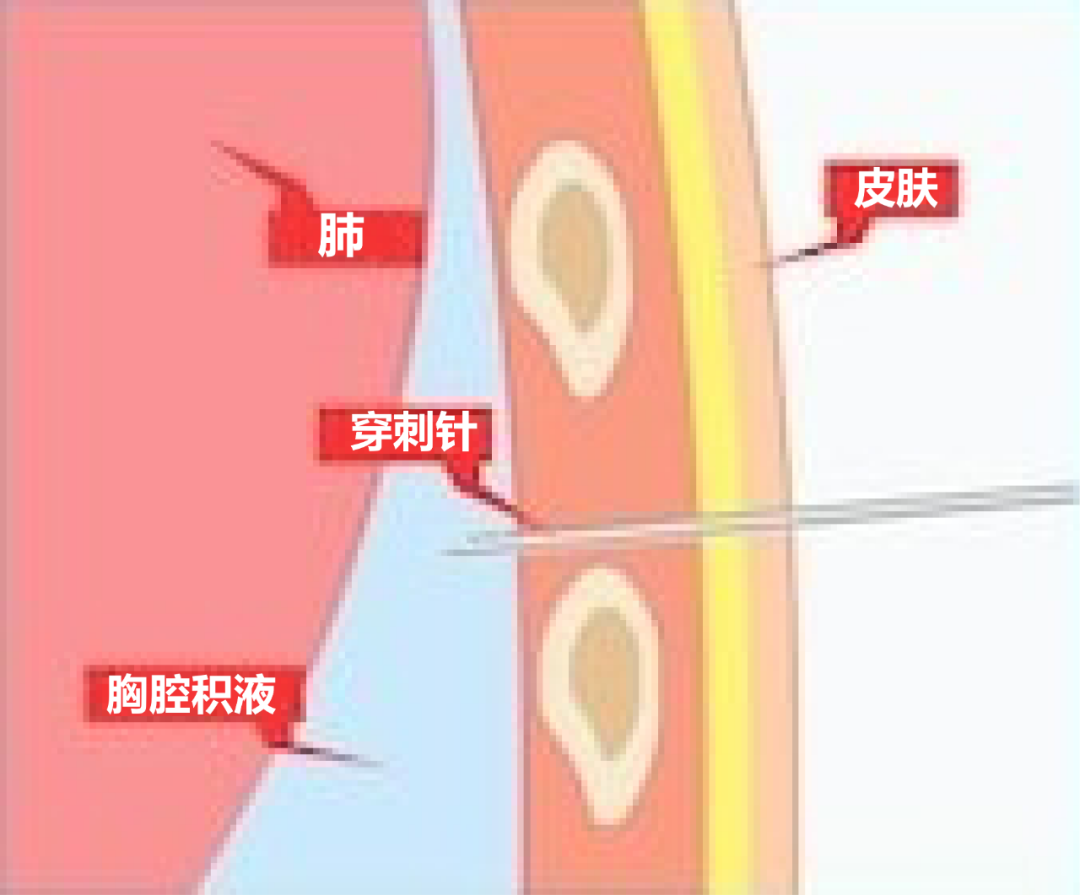 胸腔积液穿刺部位图片