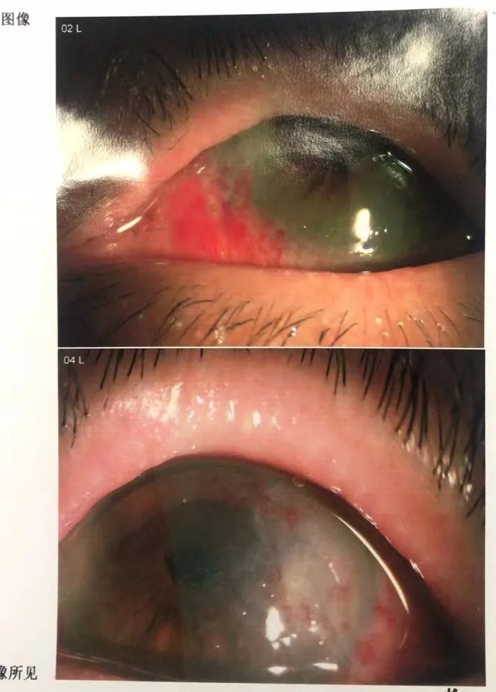 【注意】这块「肉」长在眼里吃视力，还容易反反复复长不停