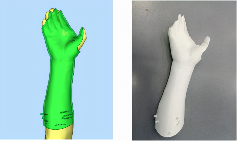 南方科技大学医院医生巧用「3D 打印+肉毒素」治疗中风后痉挛性瘫痪