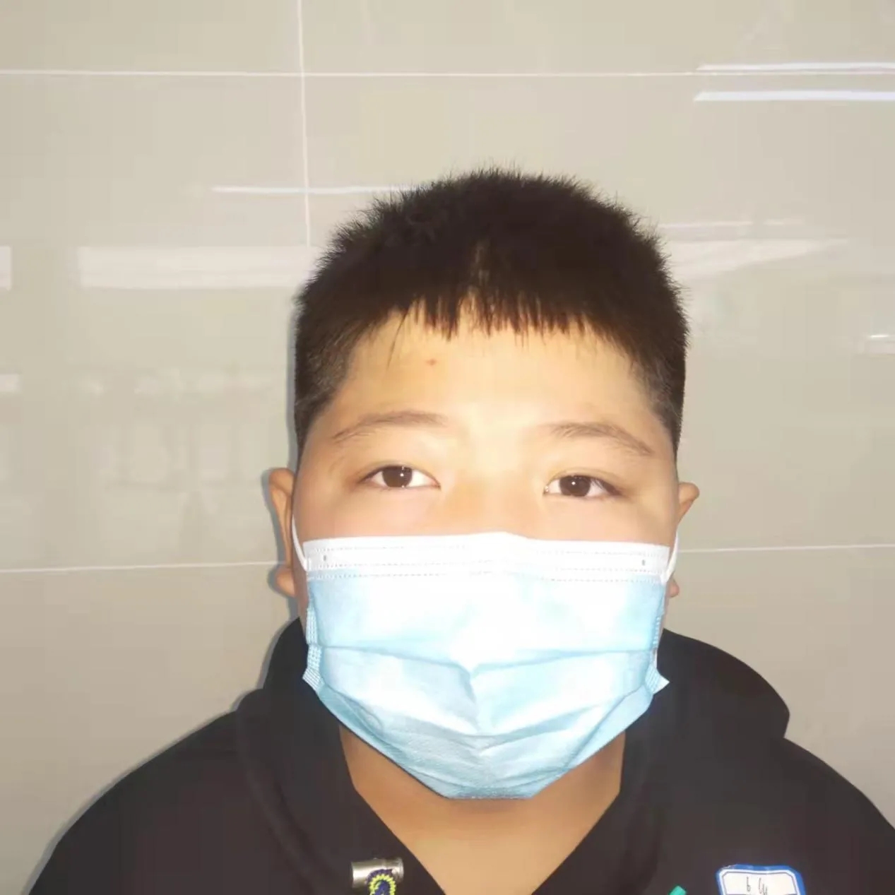 让眼性斜颈患儿回归正常生活:这个症状切勿忽视!