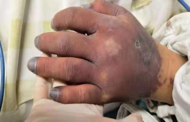 广西中医药大学第一附属医院血液内科联合 ICU 成功救治出血合并血栓的 19 岁急性白血病小伙