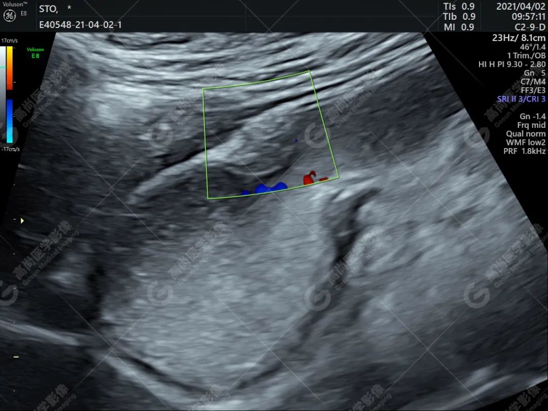 高尚超声：胃壁异位胰腺一例