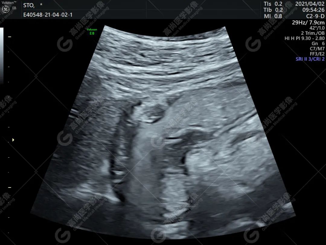 高尚超声：胃壁异位胰腺一例